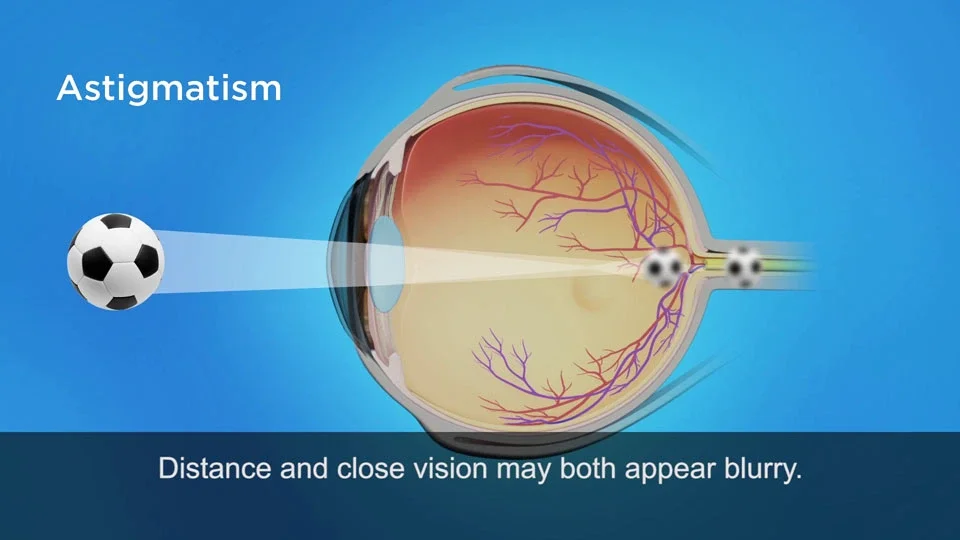 Astigmatism