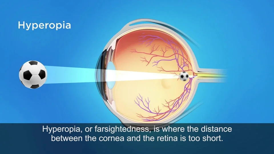 Hyperopia