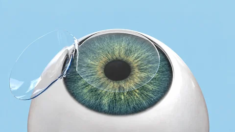 LASIK Flap Creation