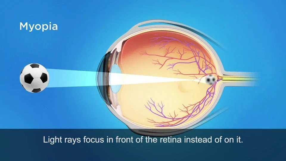 Myopia